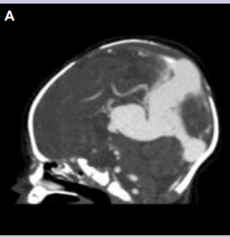 Figure 2: (A,B,C) Vein of Galen Malformation. Telencephalon [D’Souza et al. Radiopaedia].