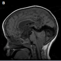 Figure 2: (A,B,C) Vein of Galen Malformation. Telencephalon [D’Souza et al. Radiopaedia].