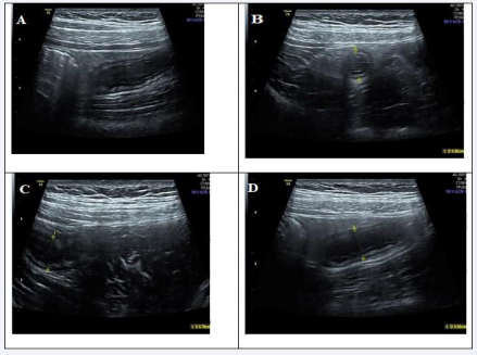 Acute appendicitis in a 12 year old male patient complaining of abdominal pain in the right iliac fossa.. (A, B) transverse and longitudinal  gray scale ultrasound views showing an acutely inflamed aperistaltic, non-compressible, dilated appendix with an 8.5-mm outer diameter. (C, D)  Note the surrounding hyperechoic inflamed fatty tissue.