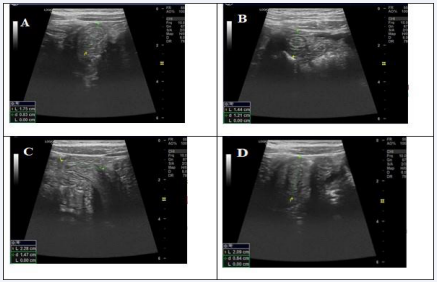 Intussusception in a 11 months old female patient complaining of intermittent abdominal pain and vomiting. (A, B) transverse lower  abdominal gray scale ultrasound views showing concentric alternating echogenic and hypoechoic bands representing Target sign.  (C, D) transverse and longitudinal gray scale ultrasound views in which the length of the lesion is 2.2 cm in maximum dimension, preserved bowel  wall motility was also noted during the scan.