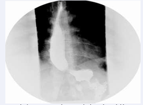 The barium image shows marked esophageal dilatation and hold up of the contrast in the reservoir created between the OGJ and the gastric band.