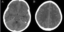 Five hours following presentation. Non contrast axial CT through the  brain in e uncus and parahippocampal gyrus (A) There was also effacement of the cerebral sulci superiorly (B) All suggestive of diffuse cerebral edema.