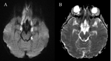 Axial diffusion weighted image through the base of the brain,  demonstrates abnormal bright signal in the inferior frontal lobes and uncal  regions bilaterally, and left hippocampal body  (A) Theseabnormalities were also dark on the ADC map  (B) Confirming restricted diffusion and acute irreversible cytotoxic edema.