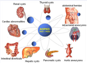 Renal and extra-renal manifestation in autosomal dominant  polycystic kidney disease