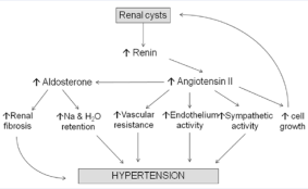  Mechanisms of hypertension in polycystic kidney disease
