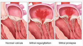 Mitral valve disease in patients with polycystic kidney disease