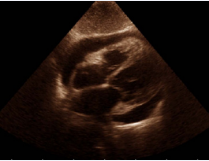 Inferior echocardiographic window showing a Pericardial Effusion in  asymptomatic patient with ADPKD