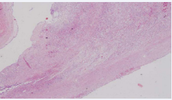 Acute cystitis with oedematous mucosa and ulceration of mucosal  surface (Haemotoxylin and Eosin staining; magnification 40x).
