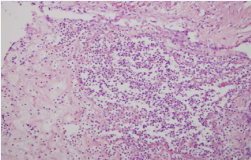 Abundant granulocytic infiltration of urinary bladder mucosa with  abscesses (Haemotoxylin and Eosin staining; magnification 100x