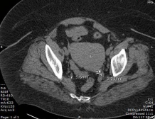  Stone present in the left ureter measuring 5.6 x 3.2mm