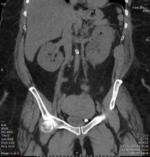 Air in the collecting system of the left kidney in the upper pole.  Presence of hydronephrosis also seen.