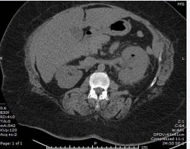 Presence of air in the upper pole of the left kidney by a coronal image