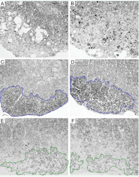 Remyelination at 270 dpi is more extensive in VP1+ mice than in  VP2+ and transgene negative mice; (A, B). Example of demyelination with no remyelination in transgene negative mice. (C,  D) Examples of extensive remyelination in VP1+ mice are outlined in blue. (E,  F) Examples of patchy, incomplete remyelination in VP2+ mice are outlined in  green. Images were taken from anterior (A, C and E) and lateral (B, D and F)  thoracic spinal cord columns, areas with prominent demyelination.