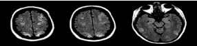 MRI brain, axial sections, with symmetric areas of abnormal T2/ FLAIR signal intensity throughout the cerebral and cerebellar hemispheres,  primarily involving the cortical and subcortical parenchyma