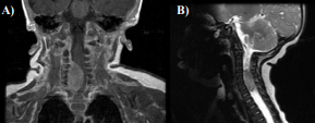 MRI of the cervical spine revealed an intraspinal extradural mass  extending from C4-T1 (panel A, T1 with contrast, coronal view; panel B, T2  sagittal view). This mass measures approximately 14 x 11 mm by approximately  24 mm craniocaudad. There is mass-effect on the spinal cord which is displaced  to the left. The mass extends into several of the right neural foramina. The mass  has mildly increased signal on T2-weighted images and intermediate signal on  T1-weighted images and shows some contrast enhancement. 