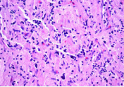 Photomicrograph showing schwannian stroma-poor neuroblastoma  (poorly-differentiated neuroblastoma), with intermediate Mitotic Karyorrhectic  Index (MKI), favorable histology (H&E stain x 400). The majority of the tumor  cells are undifferentiated neuroblasts (thick arrow). The differentiating cells  which constitute less than 5% are highlighted by the vertical arrow. A Mitosis is  seen in the right upper corner (thin arrow)
