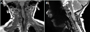 Follow up MRI performed 2 months post resection (panel A, T1  coronal view; panel B, T2 sagittal view). There is still mass-effect on the spinal  cord with deviation of the cord to the left. This is most pronounced at C5-C6.  There is continued evidence of increased soft tissue density in the right neural  foramen at C5-C6 and to a lesser degree at C6-C7. On both the sagittal and  coronal images the abnormality is centered at C5-C6.