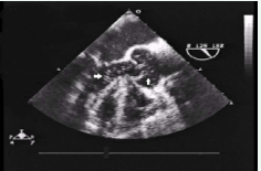 TEE demonstrating left ventricular and aortic root microbubbles  (arrows). 