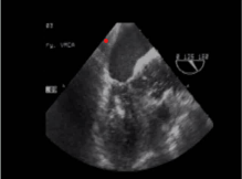Gaseous microbubbles entering the left ventricle and aortic root  during bypass are seen with TEE monitoring. TCD initially shows non-pulsatile  flow, with subsequent cerebral microembolism in both middle cerebral arteries  after release of the aortic clamp. 