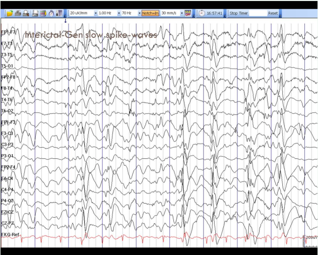 EEG revealing interictal bursts of generalized slow spike and wave complexes.