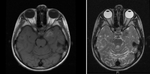 MRI of the brain (panel A axial, T1, panel B axial T2) revealed  enhancing architectural distortion of the left temporal lobe and foci of dural  enhancement.