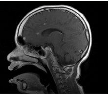  MRI of the brain (sagittal, TI sequence with contrast) revealing  multiple scattered hyperintense lesions.
