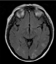 Magnetic Resonance Imaging shows increased T2 signals over the  parieto-occipital regions consistent with a diagnosis of posterior reversible  encephalopathy syndrome