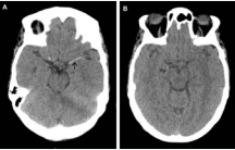 A. Non-contrast head CT shows extensive clot in the M1 segment of  the left middle cerebral artery (arrow). B. Complete resolution 30 minutes after treatment with intravenous tPA