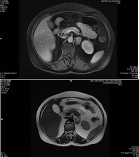 Adrenal magnetic resonance imaging [MRI] left adrenal  mass.