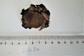 Macroscopically, the tumor excised was a 4x3x2cm  encapsulated mass, which consisted of two parts: i] dark brown  Pheochromocytoma and ii] yellowish-orange adrenal cortical  adenoma.