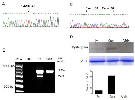 Genetic analysis of the patient. A: The DMD gene in genomic DNA was sequenced. Black arrow shows nonsense mutation in DMD. B: RT-PCR analysis of  dystrophin mRNA from exons 27–32. RT-PCR products revealed two bands. The upper band was of expected size, 793 bp. The lower band was of a shorter size, 682 bp.  The density of gel bands was analyzed using NIH Image (http://rsb.info.nih.gov/nih-image/). Density proportion was calculated on the basis of a total value of 100%.  MW: molecular–weight marker (100–base ladder); NC: no template control; Pt: patient; Con: control. C: Sequence analysis of the shorter band revealed that patient’s  cDNA lacked exon 31 in DMD. D: Upper: Western blot of total protein extract from skeletal muscle of control (Con), patient (Pt) and mouse model for muscular dystrophy  (Mdx). 25 ?g of protein were loaded in each lane. The blot was probed with NCL-DYS2 antibody. Middle: Control probe was using anti-myosin heavy chain (MHC). Lower:  comparison of relative integrated density value of the bands carried out using an NIH Image revealed a 15% dystrophin content of normal control sample.