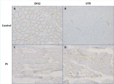 Immunohistochemistry of skeletal tissue in a control (A, B) and the patient (C, D). Skeletal muscles were stained with anti-dystrophin antibody (A, C) and  anti-utrophin antibody (B, D).