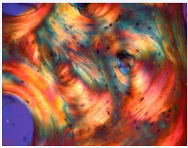 Particle of demineralized allograft viewed under polarized light demonstrating the lamellar pattern of the mature bone from which it was derived. Stevenel’s blue and Van Gieson’s picric fuchsin.