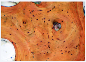 A vital osteocyte in a lacuna of a particle of demineralized allograft (green). Revascularization of the particle of demineralized allograft is required. Stevenel’s blue and Van Gieson’s picric fuchsin.