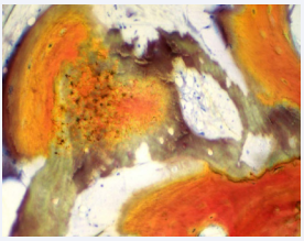 Particle of demineralized allograft that is being re-ossified. New bone formation (yellowish-green stain) lined by osteoblasts is forming along the surface of the demineralized allograft. Stevenel’s blue and Van Gieson’s picric fuchsin.