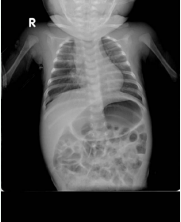 Chest radiograph showed coarsening of interstitial markings  on the bilateral medial lung fields and the ileus.