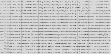 Electroencephalogram recorded during respiratory distress showed periodic polyspikes on the left fronto-centro-parietal region