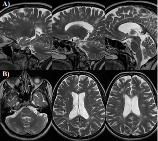 Axial T2 images show multiple bilateral T2 hyper intensities involving periventricular white matter, corpus callosum, brainstem and  serebeller white matter . On saggital T2 sections most of the lesions are perpendicular to lateral ventricle-Dawson’s finger.