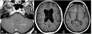 Axial postcontrast T1-WI demonstrates concentric ring-enhancing lesions (arrows) in the infratentorial (a) and periventricular (b) regions.  Characteristic open-ring enhancing lesion with increased specificity for MS (c).