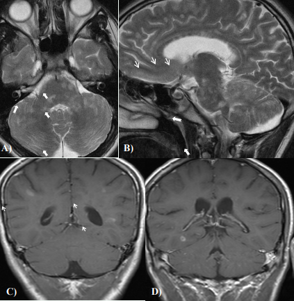 A) Axial T2 scan through the pons showing multiple hyperintense lesions. Arrows highlight only some of the lesions. B) Sagittal T2 scan  showing multiple lesions in the pons (thick arrows) and in the corpus callosum (thin arrows). The arrows highlight only a few of the lesions. C & D) Coronal T1 scans with contrast, shows multiple enhancing lesions in the cerebral hemispheres (arrows).