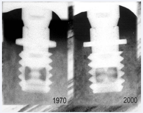One very early implant design with flanges used by P-I Brånemark and his team between 1965 and 1970. The radiogram to the right is a 30-year control.