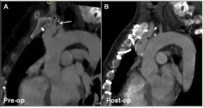 Imaging of the right common carotid artery origin. A. Pre-operative CT angiogram, Arrow shows likely location of positiondependent carotid origin impingement B. Post-operative CT angiogram *Connection to right common carotid artery. ^Connection to right axillary artery  (pre-op this is an axillo-axillary bypass, post-op this is an aorto-axillary graft)