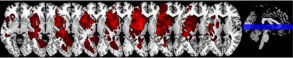 Lesions overlay of the RHS patients. An overlay of the lesions of the  28 patients with the right hemisphere stroke (RHS). Nine slices are presented  with all strokes from all the patients overlaid. 