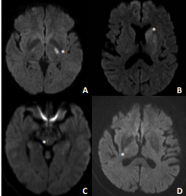 Diffusion weighted MRIs of Patients 1,3,4, and 7 showing diffusion  bright lesions in: A) internal capsule, B) corona radiata, C) midbrain, and D)  internal capsule consistent with small vessel acute ischemic strokes. An * marks  the site of diffusion restriction for each case