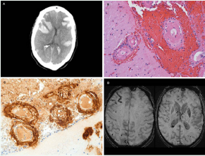 (A) CT scan of patient 1 demonstrating multifocal ICH including  subarachnoid, intraparenchymal, and intraventricular components. (B)  Hematoxylin and eosin stain demonstrating hemorrhage and “doublebarrel” appearance of vessels in amyloid angiopathy from patient 1. (C)  Immunohistochemistry demonstrating amyloid beta deposition in the vessel  walls of patient 1. (D) Susceptibility-weighted MRI of patient 2 demonstrating  numerous lobar microhemorrhages.