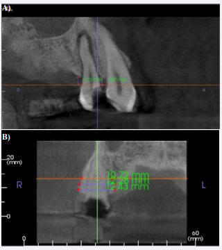 Pre- Extraction Measurement Examples (a) – Image is a sample CBCT slice taken from the frontal plane. Image shows pre-extraction measurements including the rVRP mesial and distal to a hopeless tooth (b) - Image is a sample CBCT slice taken from the sagittal plane. Image shows measurements including the pre-extraction ridge width (at h3 mm, h5 mm and h7mm)