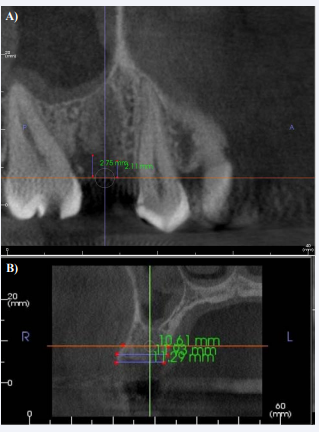 Post- Extraction Measurement Examples (a) – Image is a sample CBCT slice taken from the frontal plane. Image shows post-extraction measurements including the rVRP mesial and distal to the extracted tooth (# 4) site (b) -Image is a sample CBCT slice taken from the sagittal plane. Image shows measurements including the ridge width (at h3 mm, h5 mm and h7mm from CEJ)