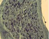  Nerve biopsy showed reduction in the myelinic fiber number,  suggesting axonal degeneration without onion bulbs or clusters.