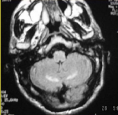 Magnetic resonance imaging revealed hyper intense signals in  mesencephalic peduncles, protuberance and cerebellar hemispheres