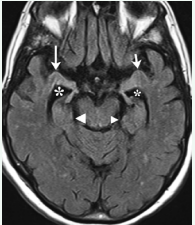 1.5 Tesla MRI, fluid attenuated inversion recovery sequence, axial  plane, showing atrophic amygdala (right: large arrow, left: short arrow). For  the smaller right and larger left hippocampus see large and small arrow head,  respectively. The temporal horn of the right lateral ventricle (large asterisk) is  slightly larger than the left one (small asterisk).